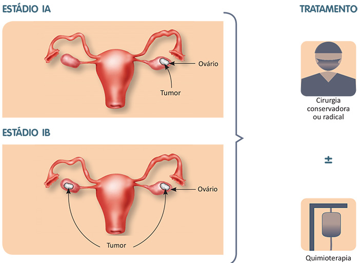 Câncer confinado a um dos ovários