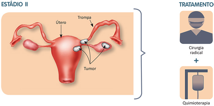 Como é o pós-operatório da cirurgia de câncer de ovário