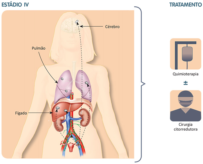 Metástases pulmonares, hepáticas, cerebrais e o tratamento específico para essa fase da doença.