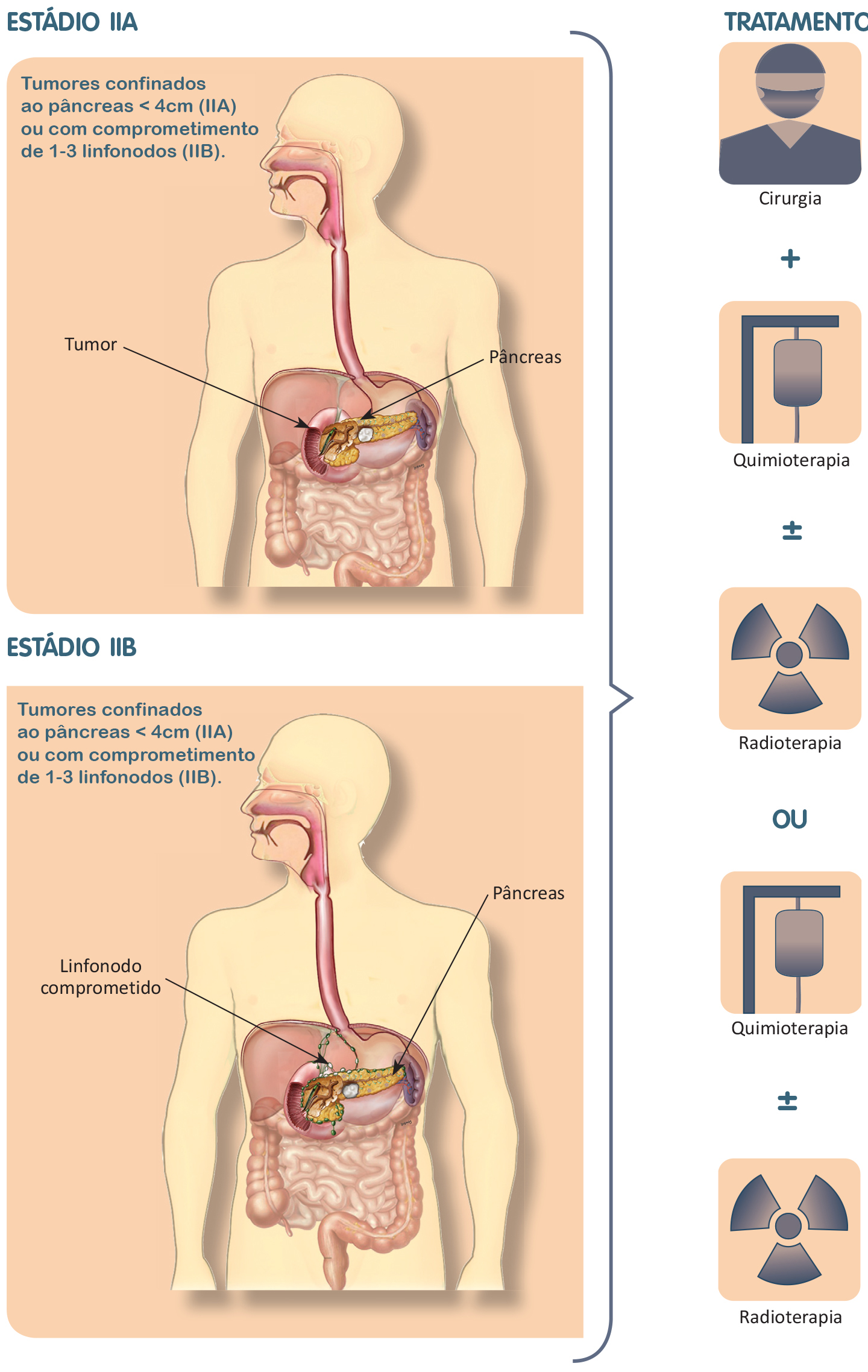Tratamento do câncer de pâncreas estádio 2.
