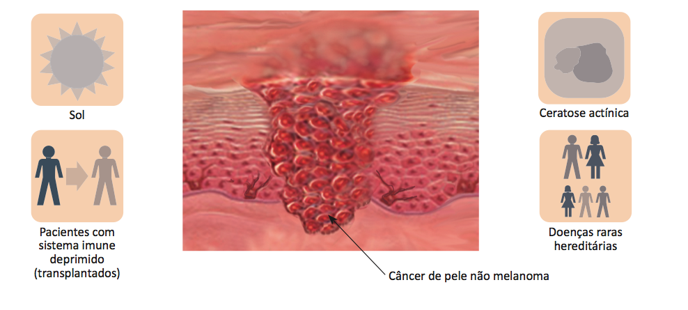 Fatores de risco para câncer de pele não melanoma.