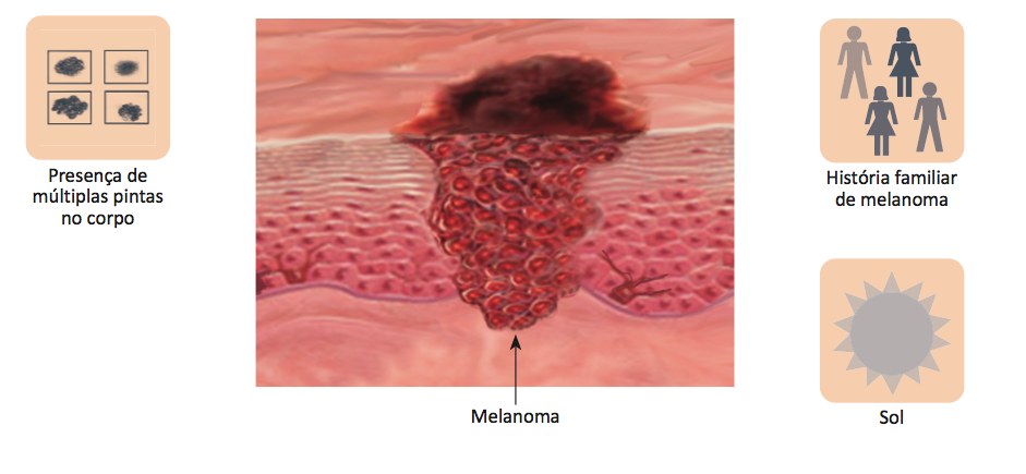 Fatores de risco mais comuns para melanoma de pele.