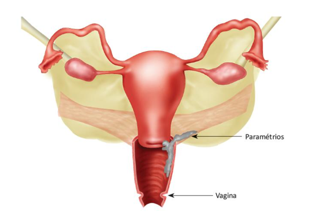 Crescimento local do câncer de colo uterino.