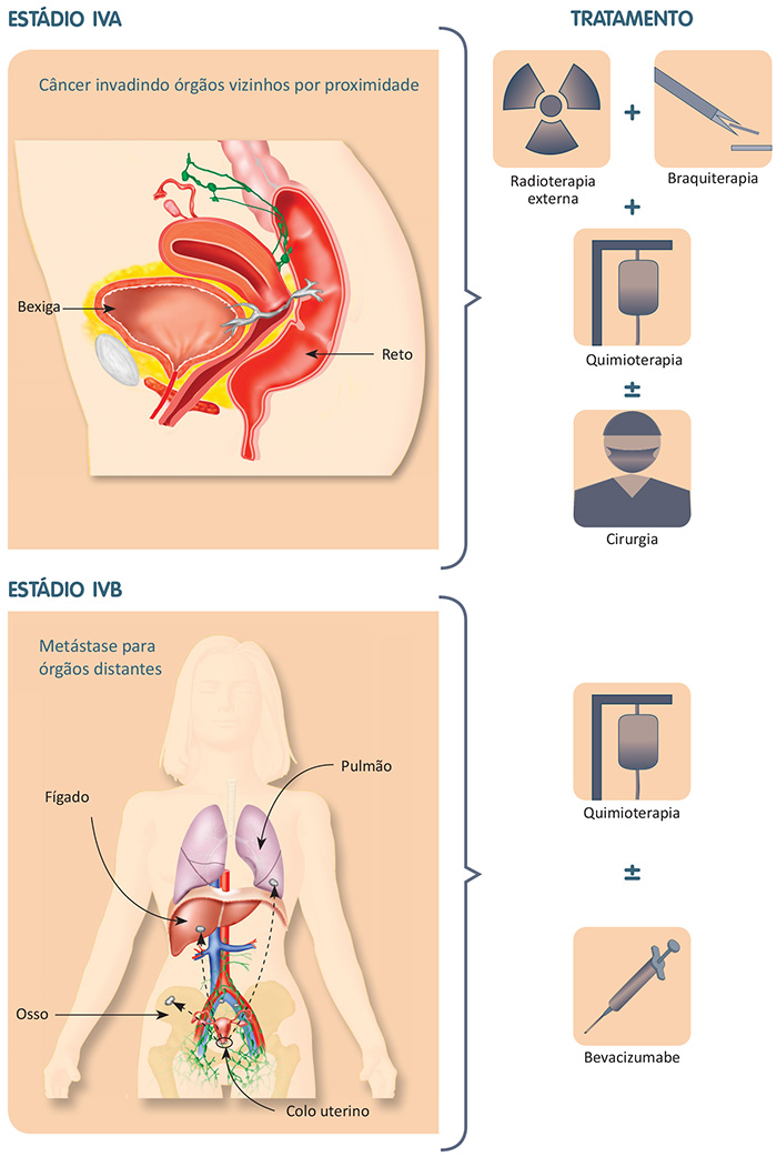 Câncer de colo do útero invade os órgãos adjacentes