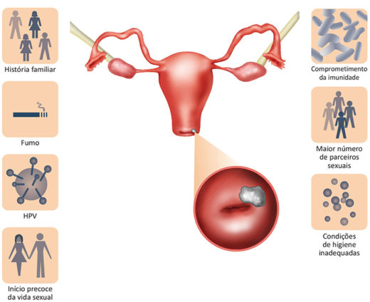 Câncer De Colo Do útero Fatores De Risco Vencer O Câncer Vencer O Câncer