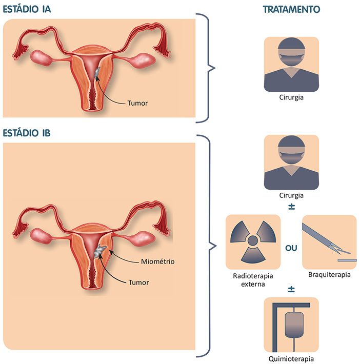 Câncer confinado ao corpo uterino invadindo somente o endométrio