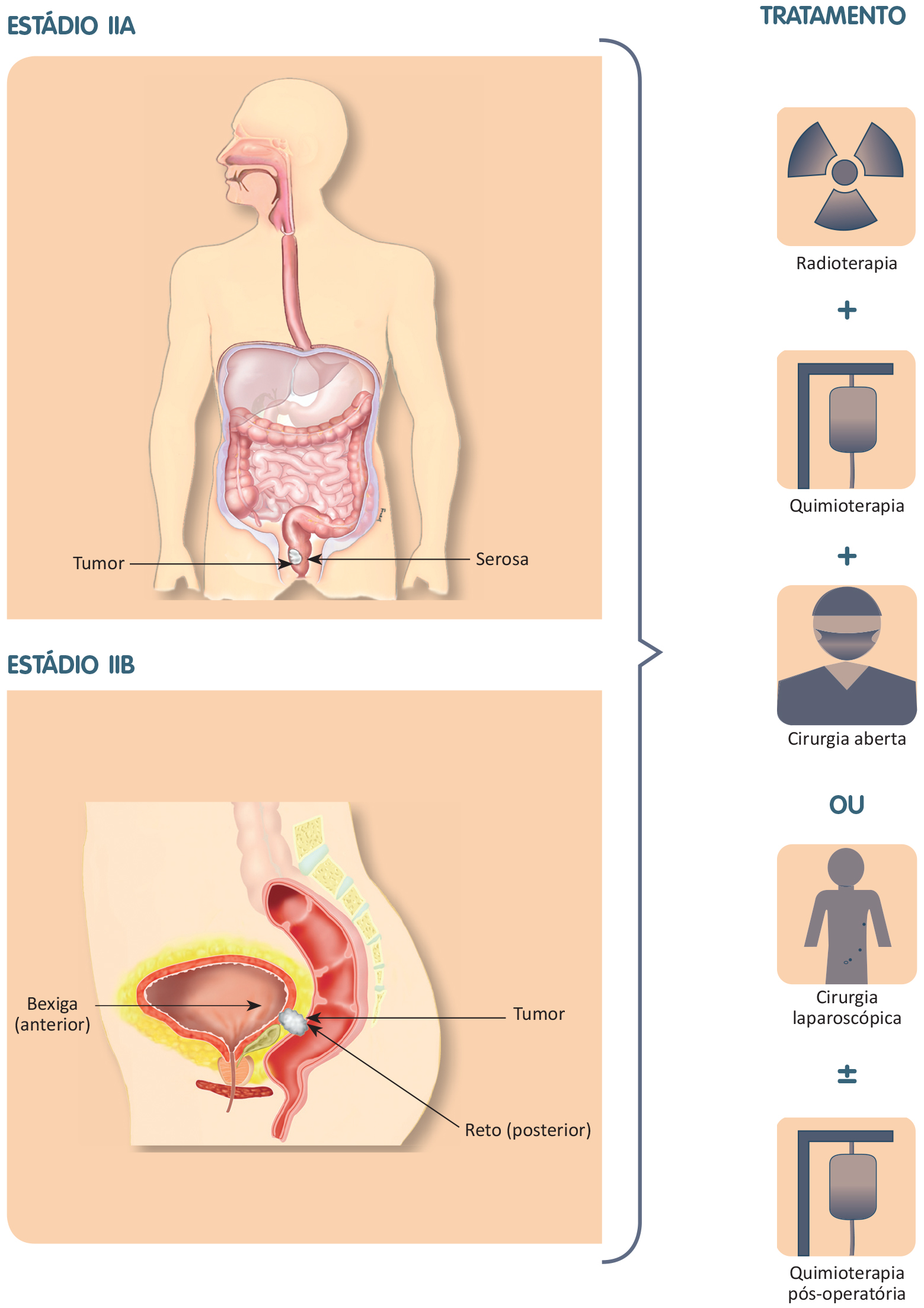 Cancerul de colon – Spitalul Universitar de Urgenţă Militar Central Dr. Carol Davila