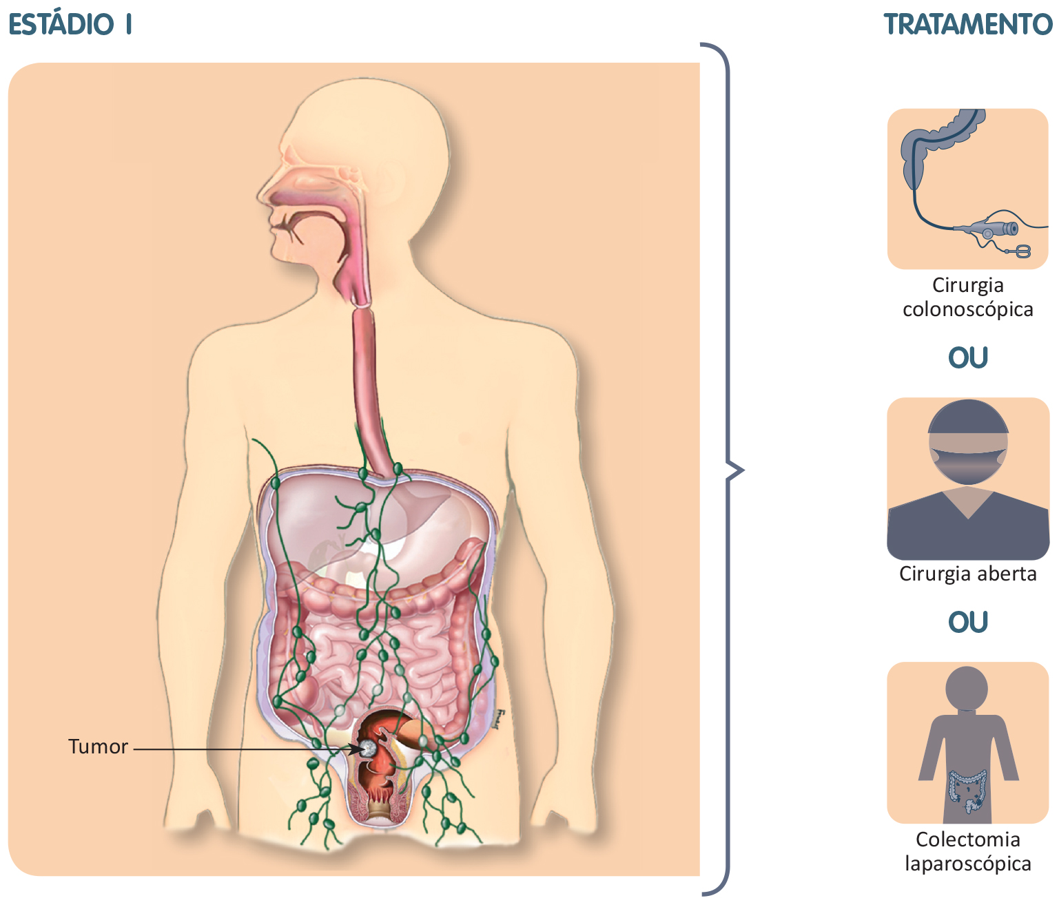 cancer de colon nivel 4 control de helminthosporium en sorg