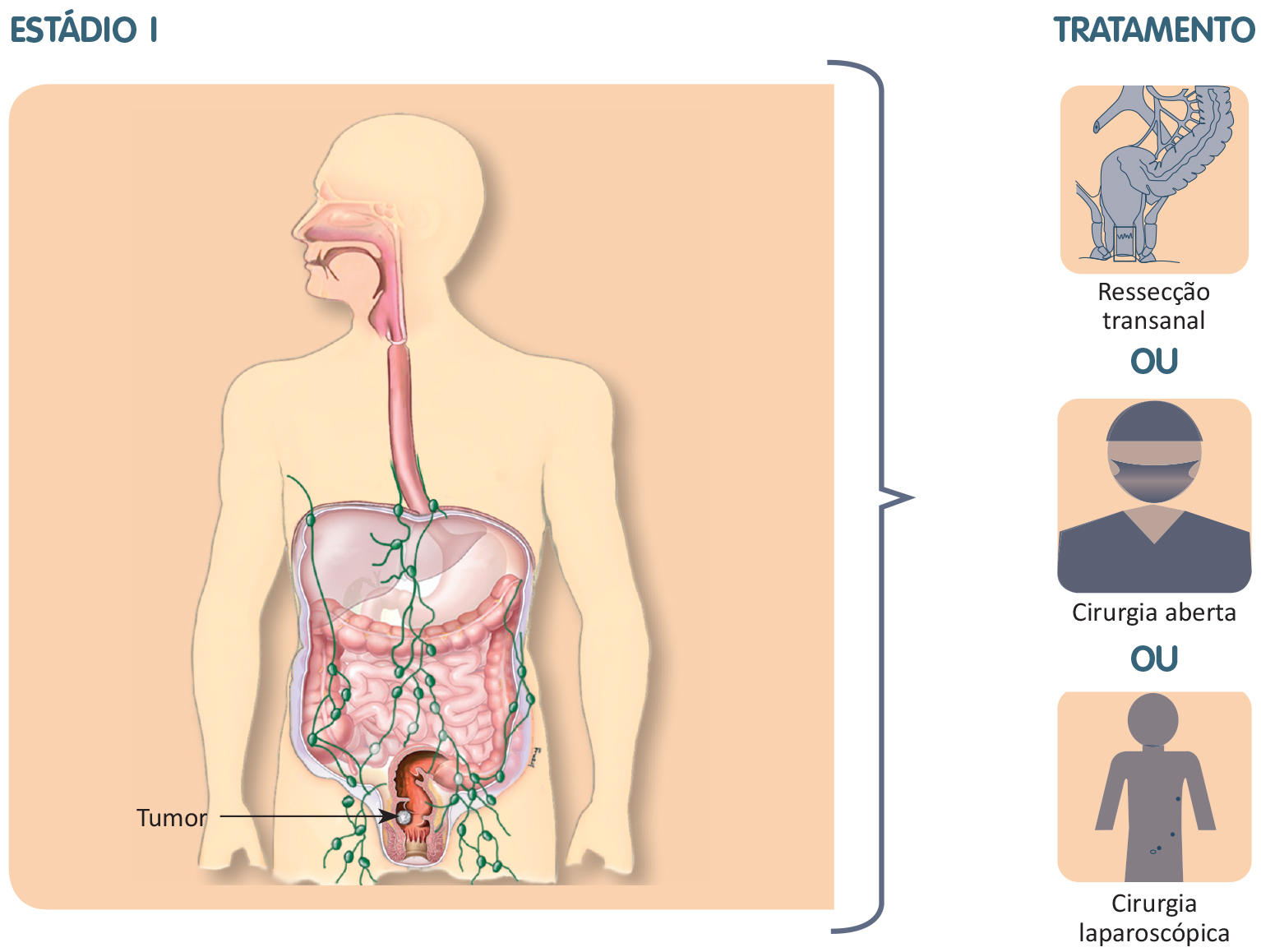 Tratamento do câncer colorretal - Estádio I / tumor - Ressecção transanal, cirurgia aberta ou cirurgia laparoscópica