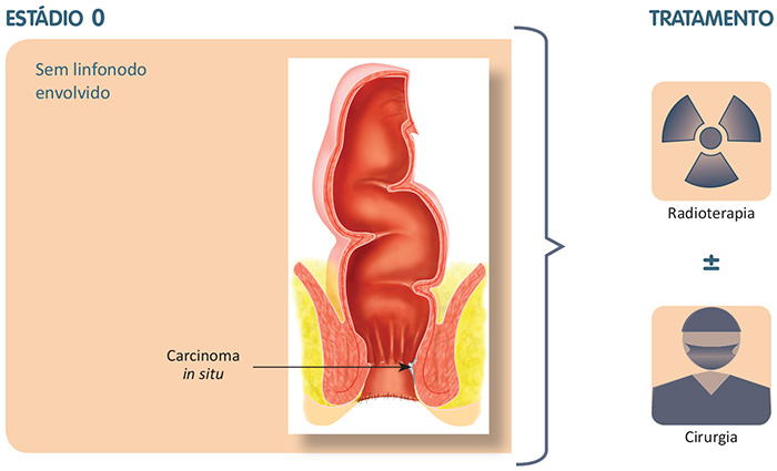 Carcinoma in situ