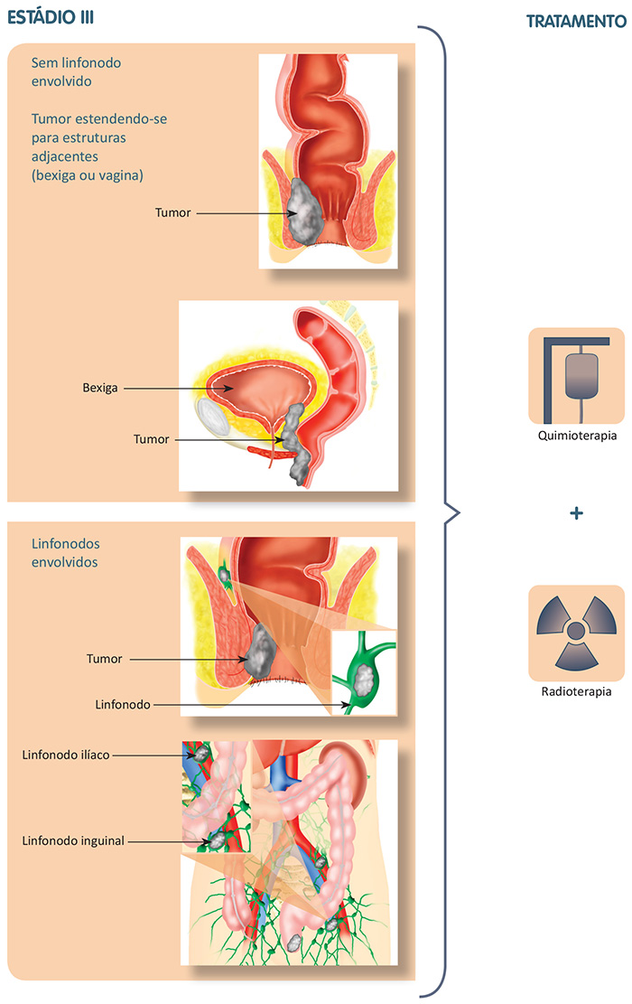 Tratamento do estádio III do câncer de canal anal