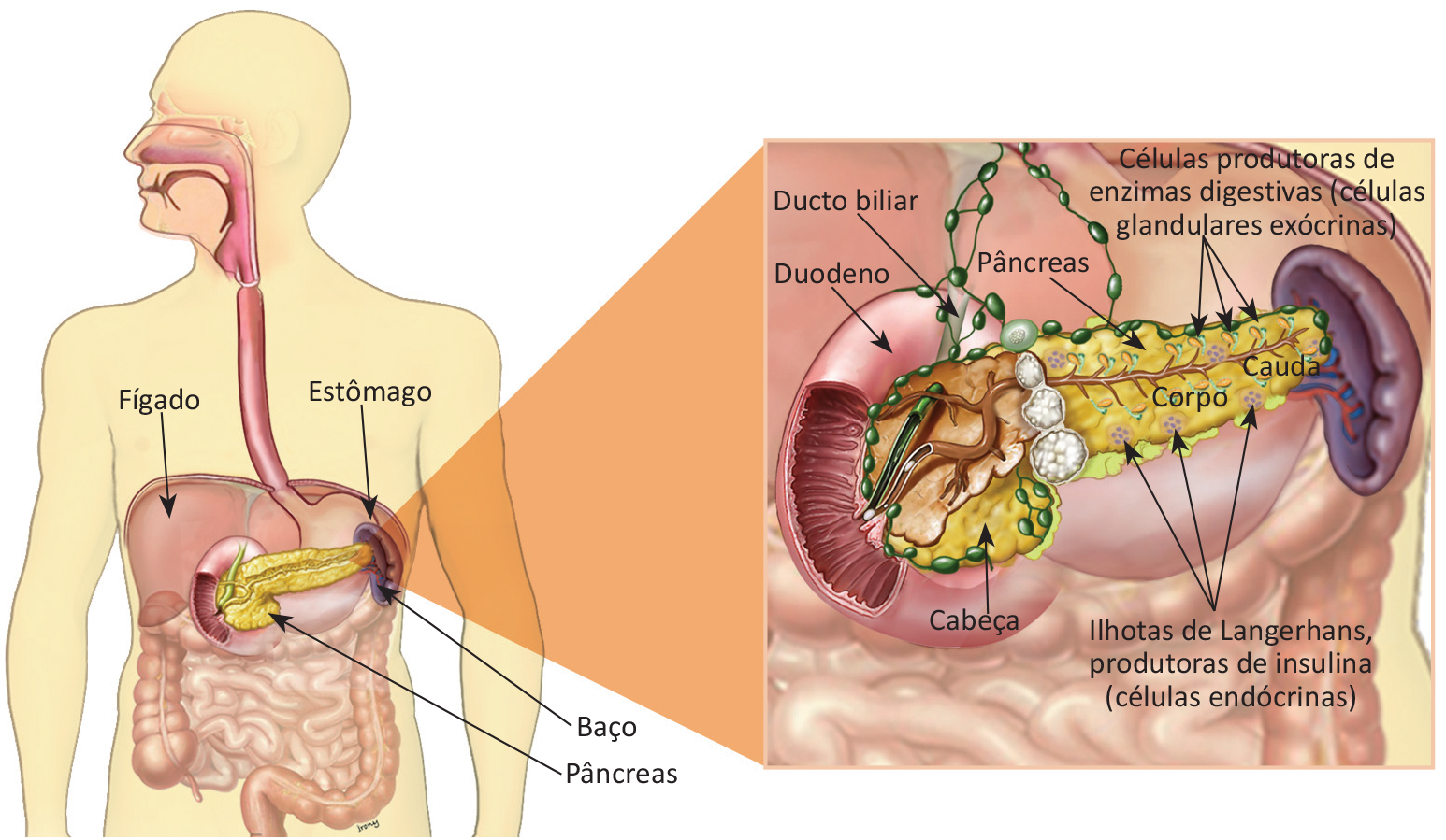 Crescimento local do câncer de pâncreas