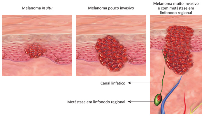 História natural do melanoma de pele