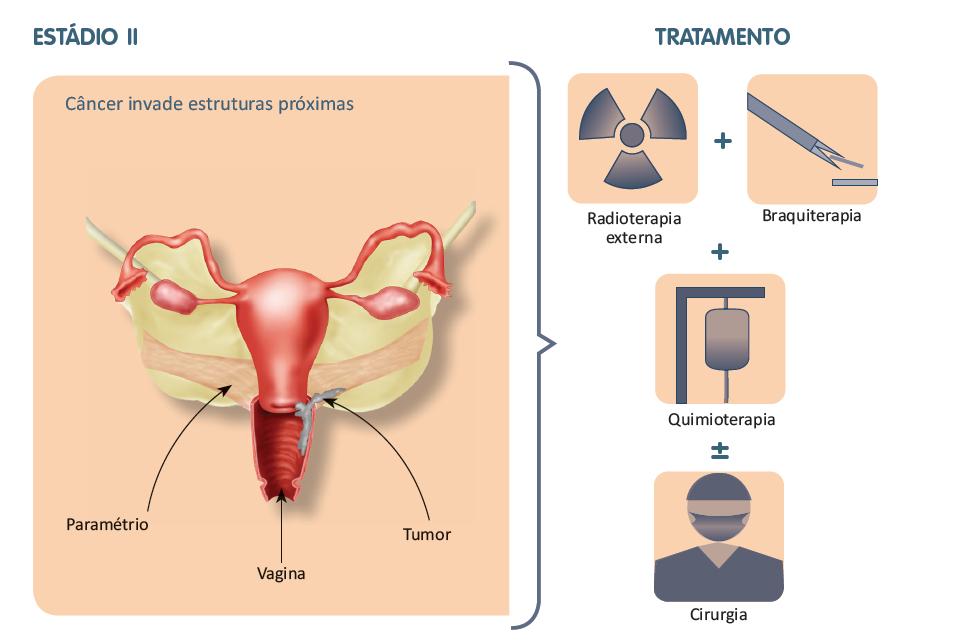 Câncer de colo do útero | Tratamento