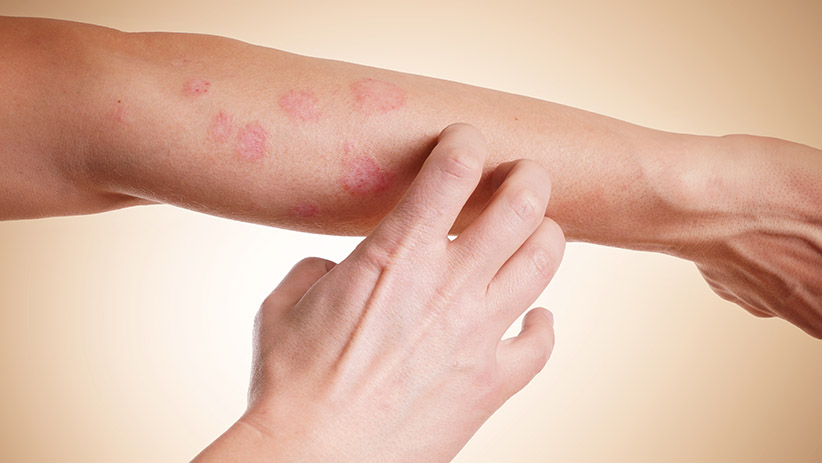 Manchas vermelhas podem indicar câncer de pele?