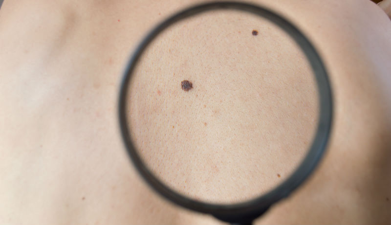 Inimigo silencioso, melanoma é tipo letal de câncer de pele