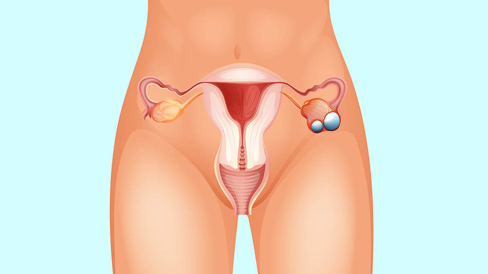 Ilustração de câncer de ovário.