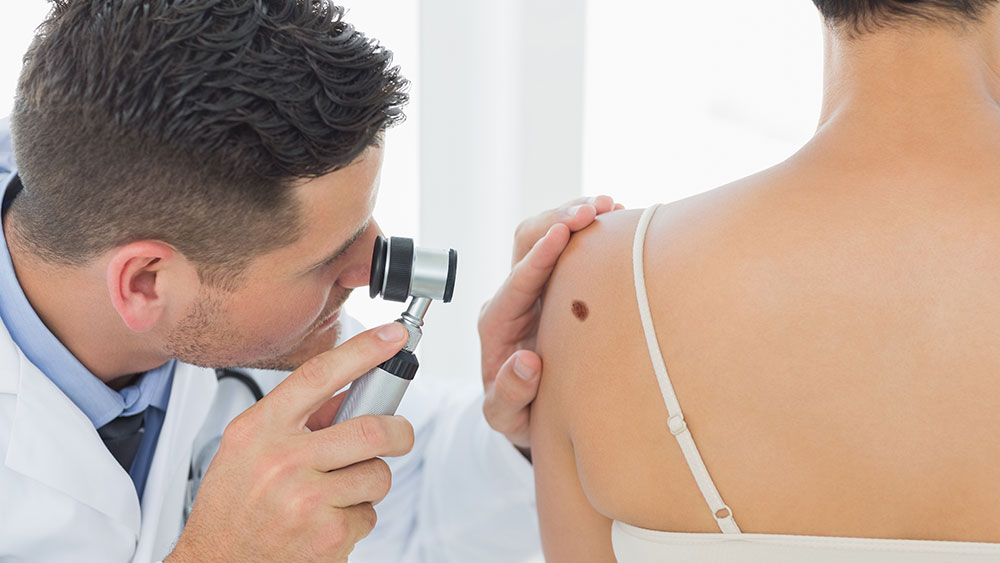 Mês internacional do melanoma: você já teve todas suas pintas analisadas pelo dermatologista?