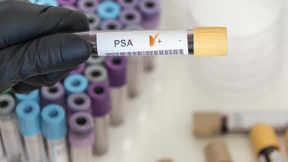 Exame de PSA para identificar Câncer de Próstata