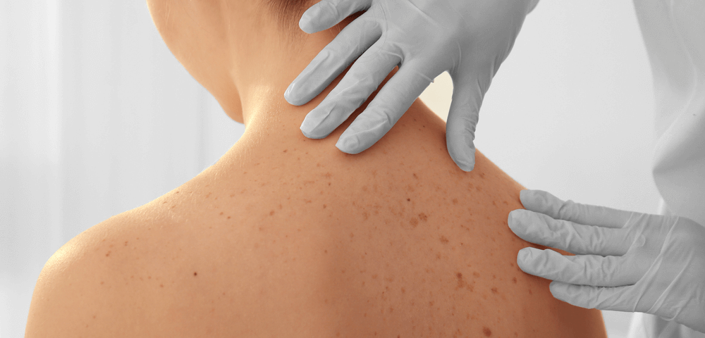 Prevenção e cuidados no câncer de pele melanoma – muito além da atenção na exposição ao sol