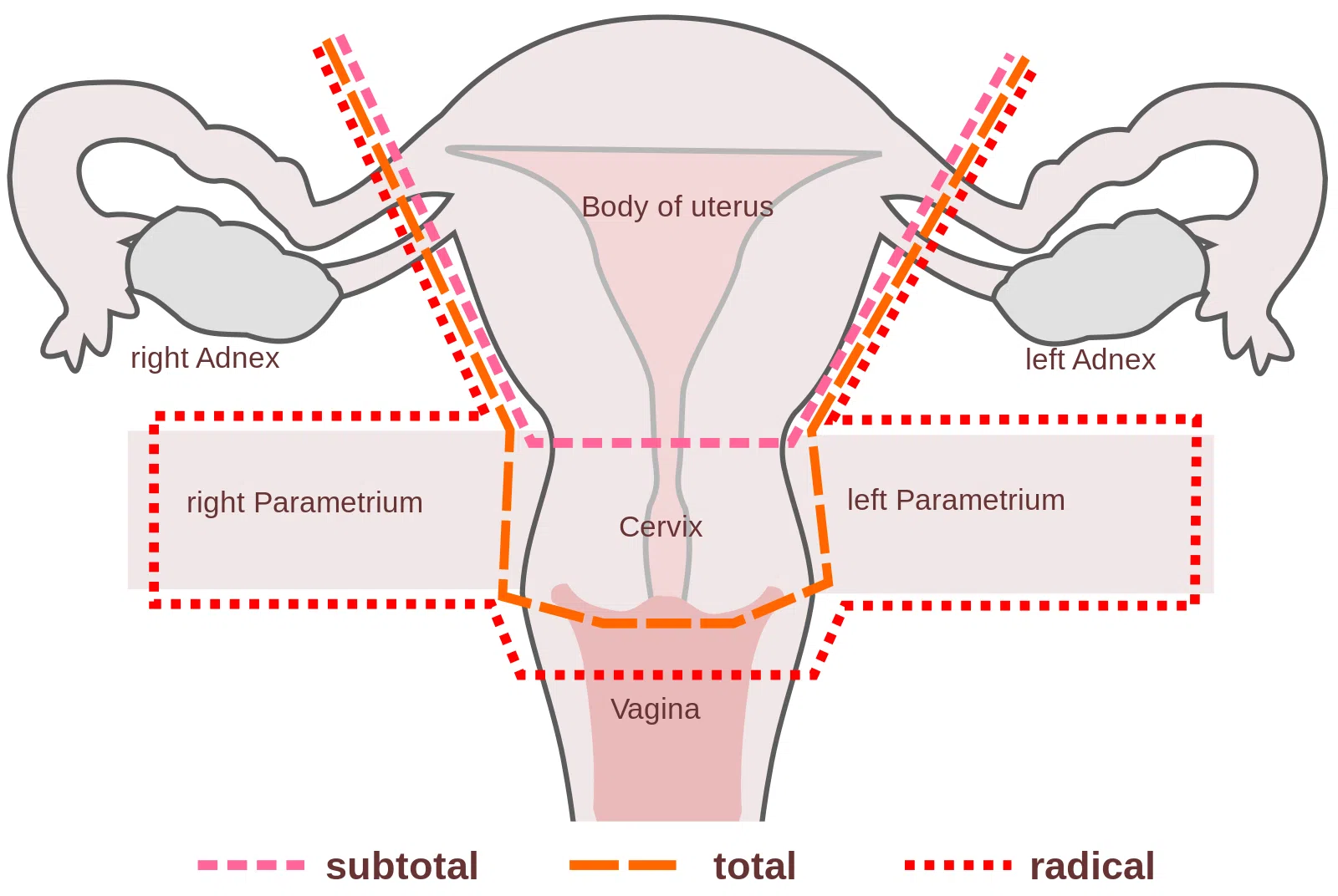 Diagrama dos tipos de histerectomia