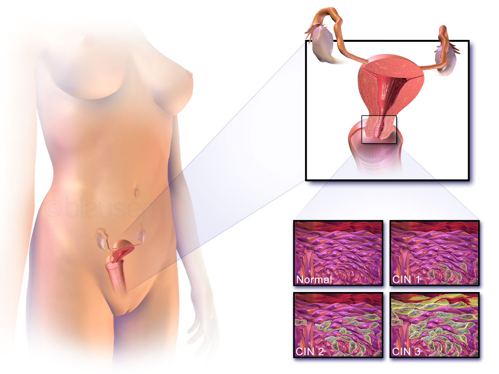 Câncer de colo do útero