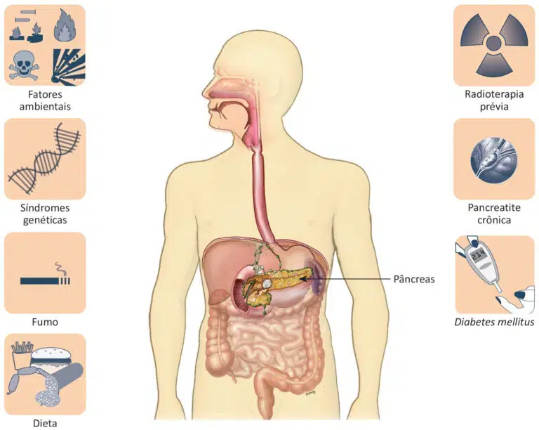 Fatores de risco do câncer de pâncreas.