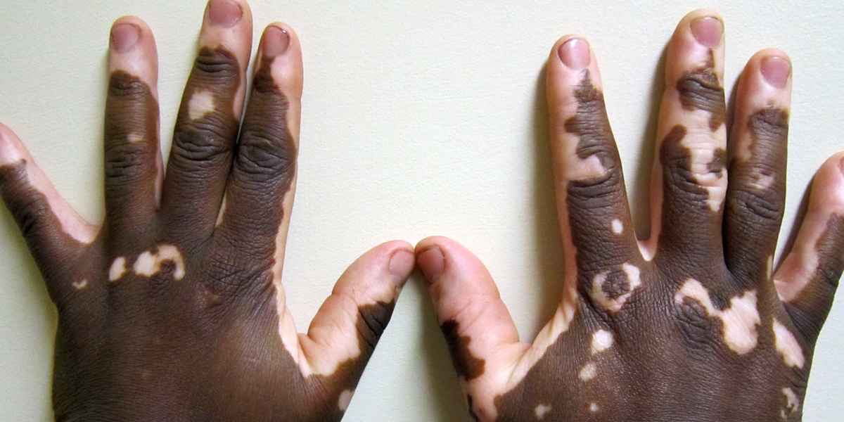 vitiligo - manchas na pele