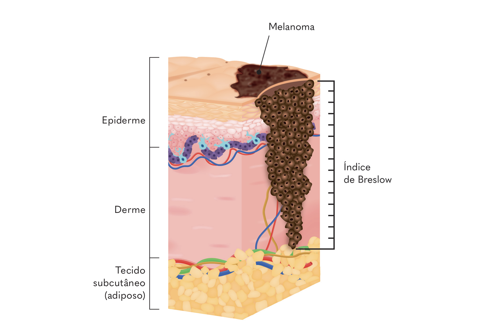 Recaída do câncer de pele (melanoma e não melanoma)