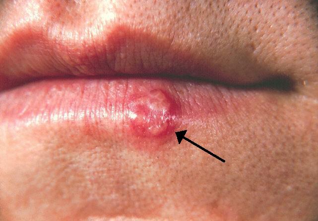 Herpes labial
