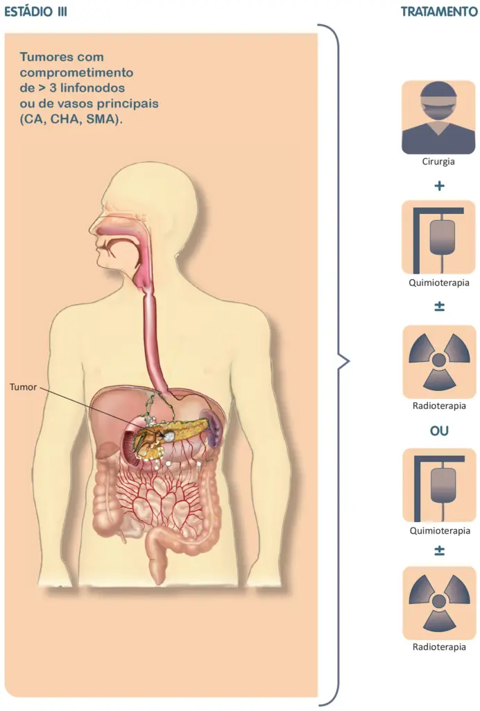 Tratamento do câncer de pâncreas