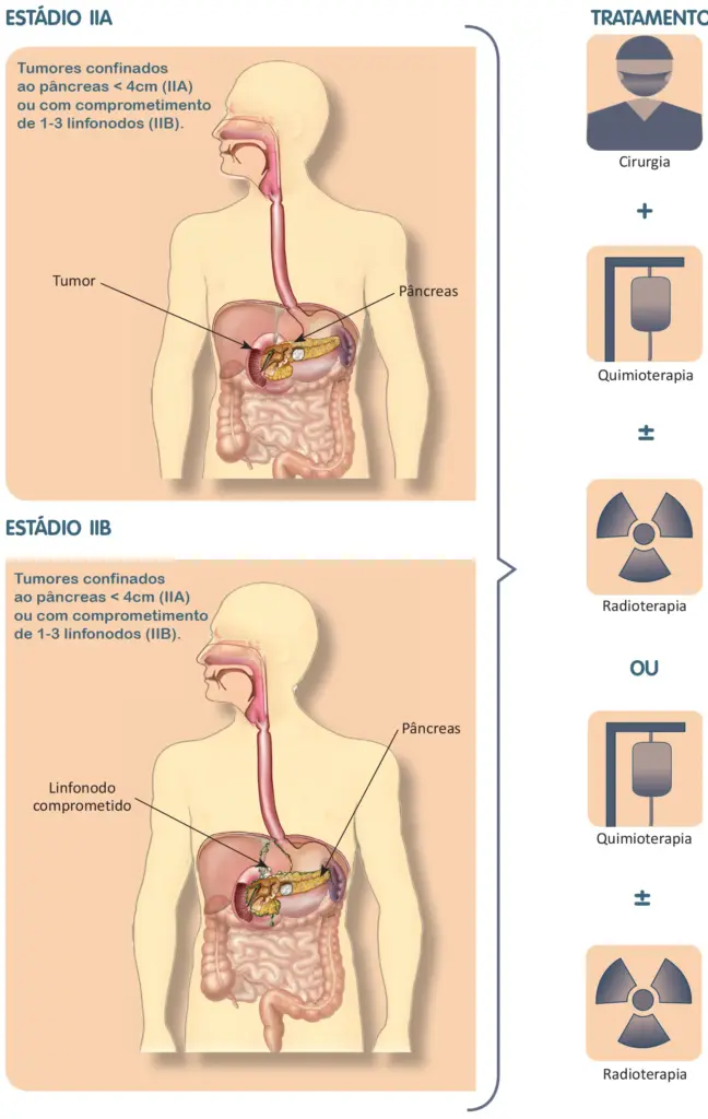 Tratamento do câncer de pâncreas