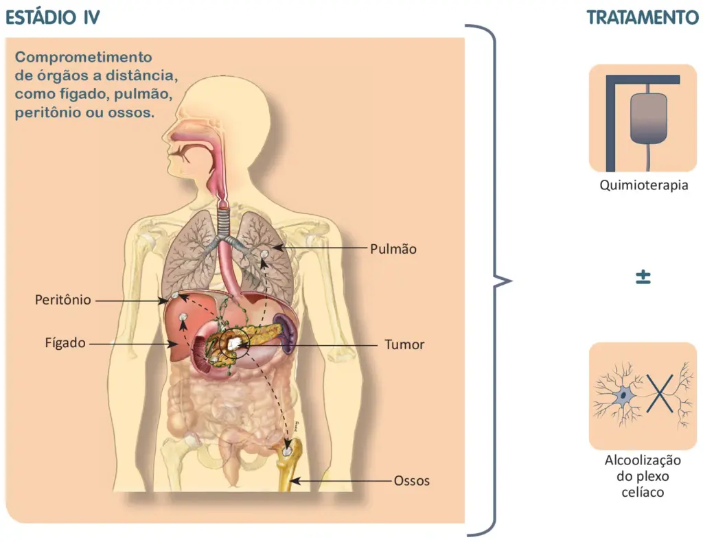 Tratamento do câncer de pâncreas