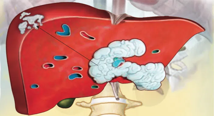 O que é câncer de fígado