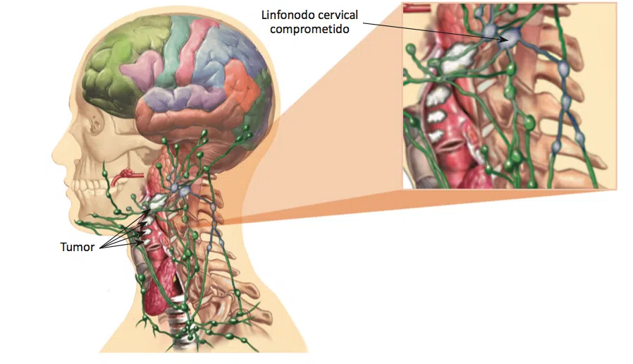 O que é câncer de cabeça e pescoço?