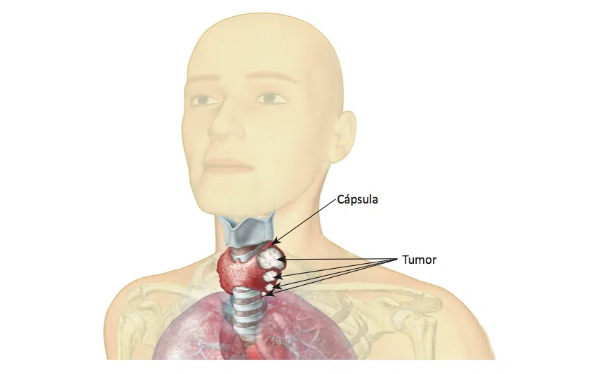 O que é câncer de tireoide?