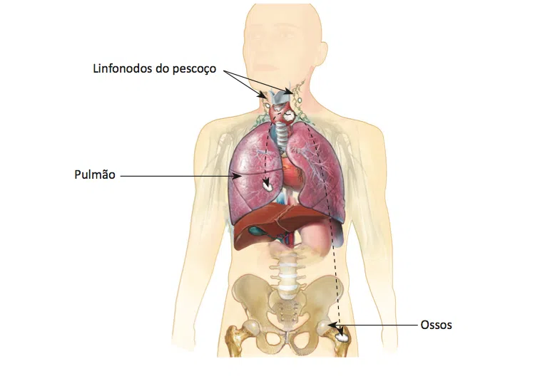 O que é câncer de tireoide?
