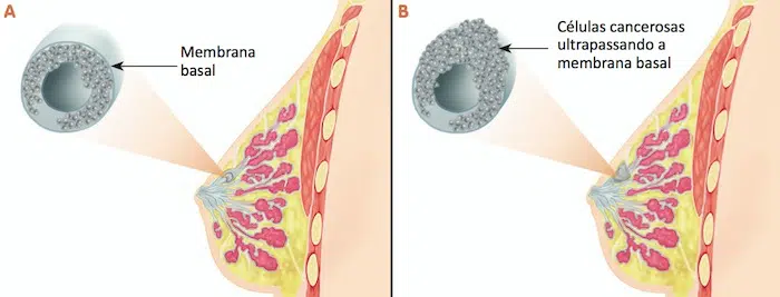 Tipos de câncer de mama