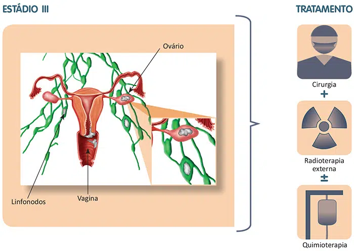Tratamento do câncer de endométrio