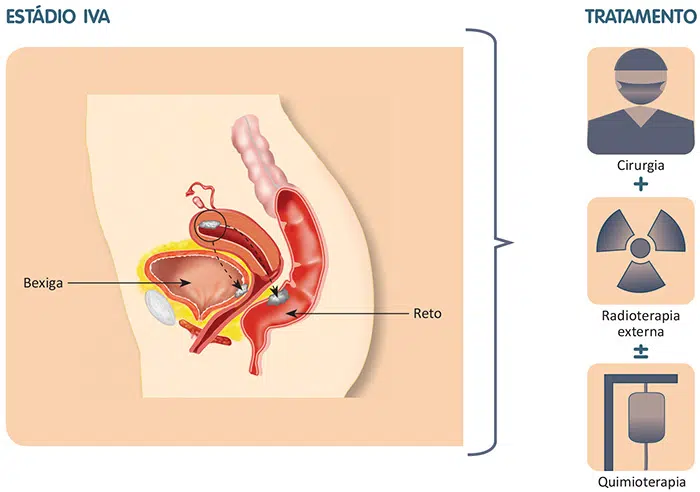 Tratamento do câncer de endométrio