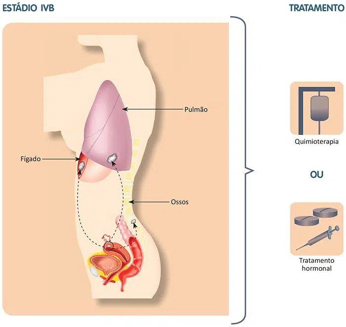 Tratamento do câncer de endométrio