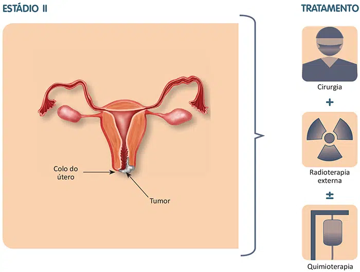 Tratamento do câncer de endométrio