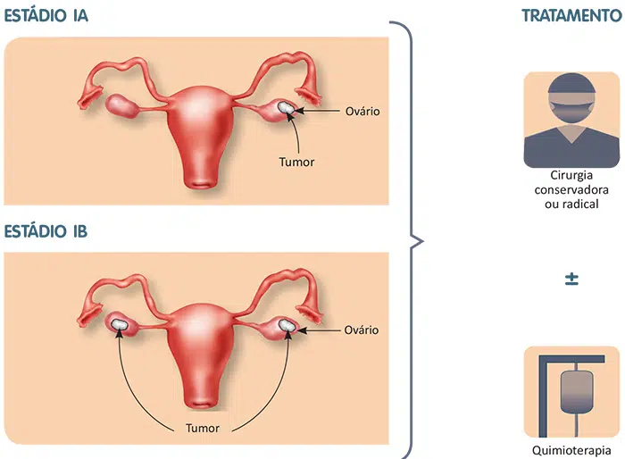 Tratamento do câncer de ovário