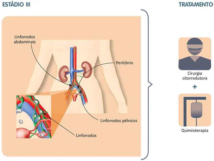 Tratamento do câncer de ovário