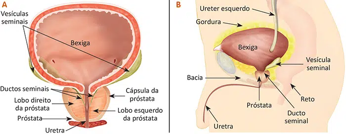 O que é câncer de próstata?