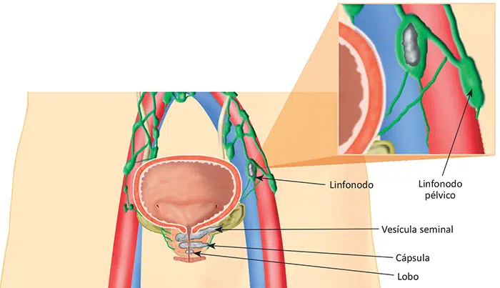 O que é câncer de próstata?