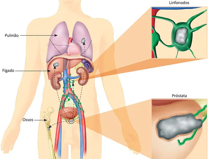 O que é câncer de próstata?