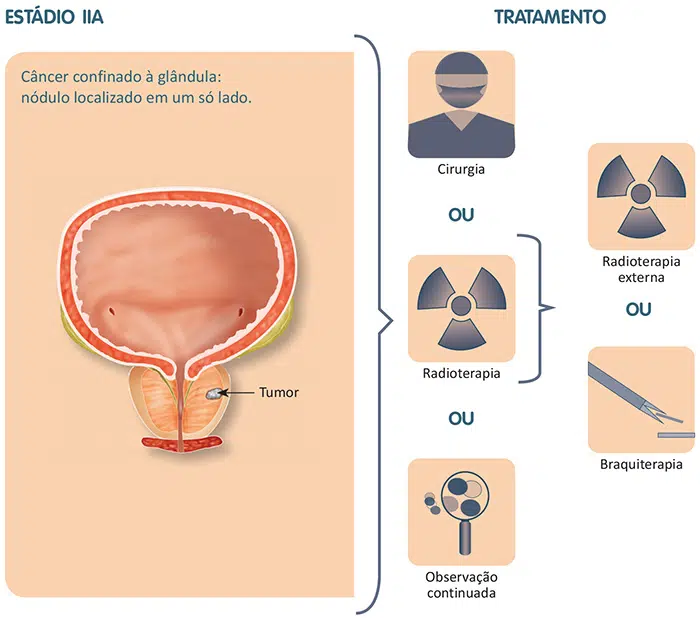 Tratamento do câncer de próstata