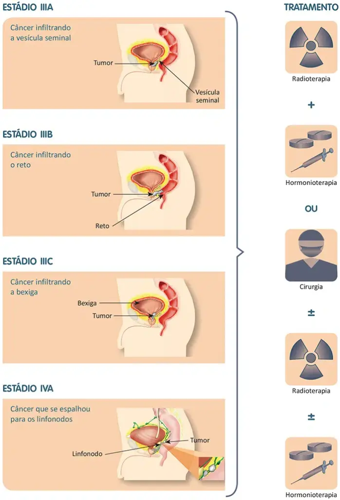 Tratamento do câncer de próstata