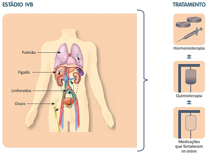 Tratamento do câncer de próstata
